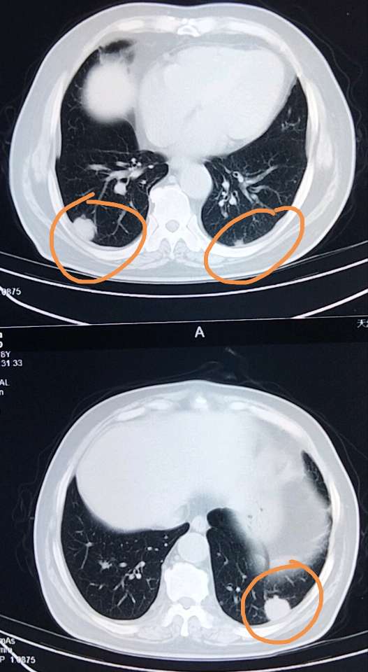 刘懿博士说肺癌五六七七肺部多发类圆形结节建议做petct