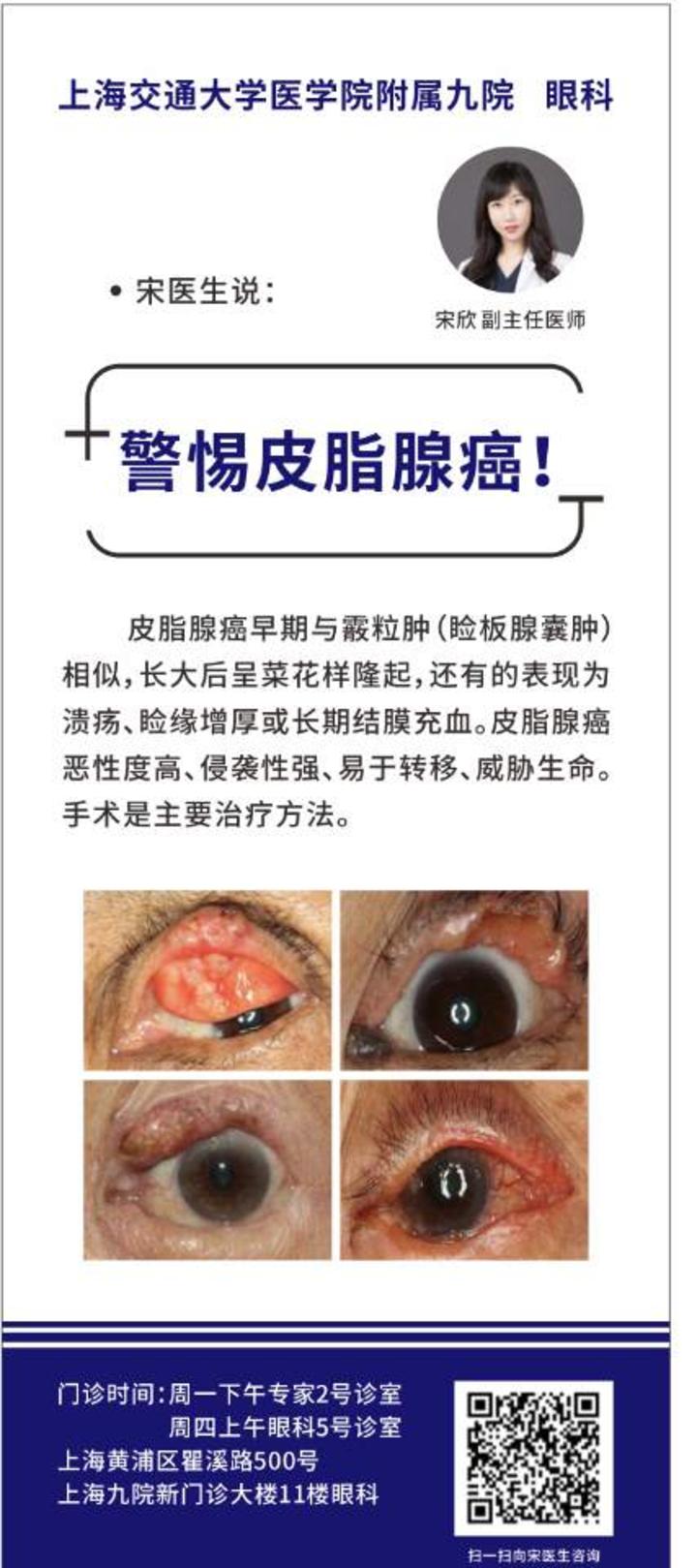 眼皮上长疙瘩眼皮总是溃疡长期结膜充血警惕皮脂腺癌