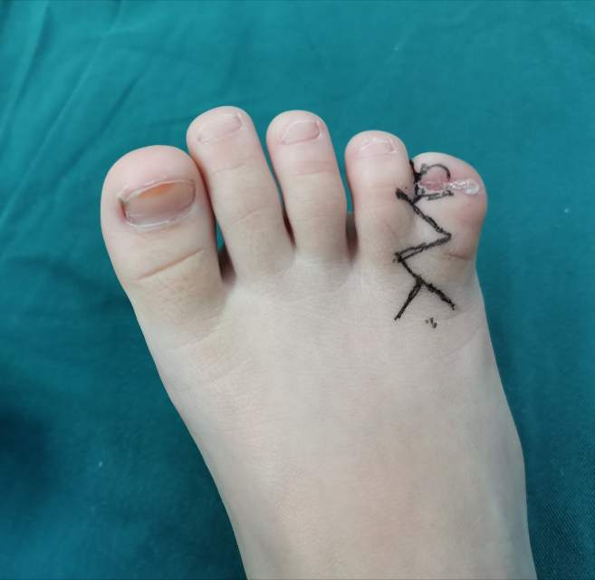 了解一下足部并指畸形及如何手术治疗