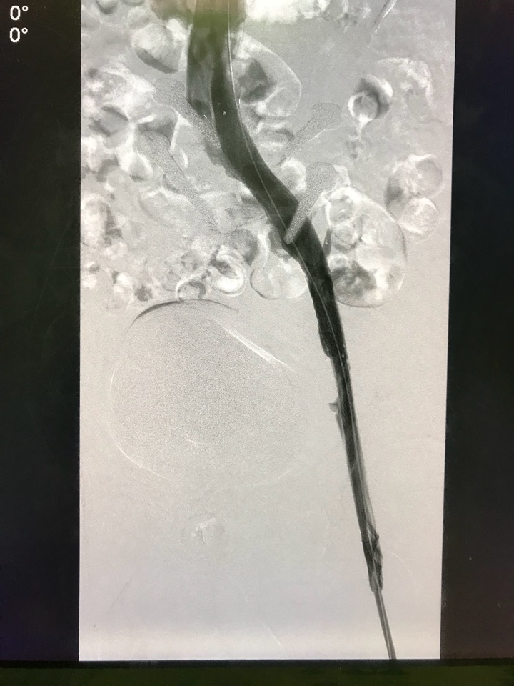 10年深静脉血栓后遗症,一朝解除