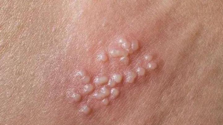 生殖器疱疹治疗方案选择