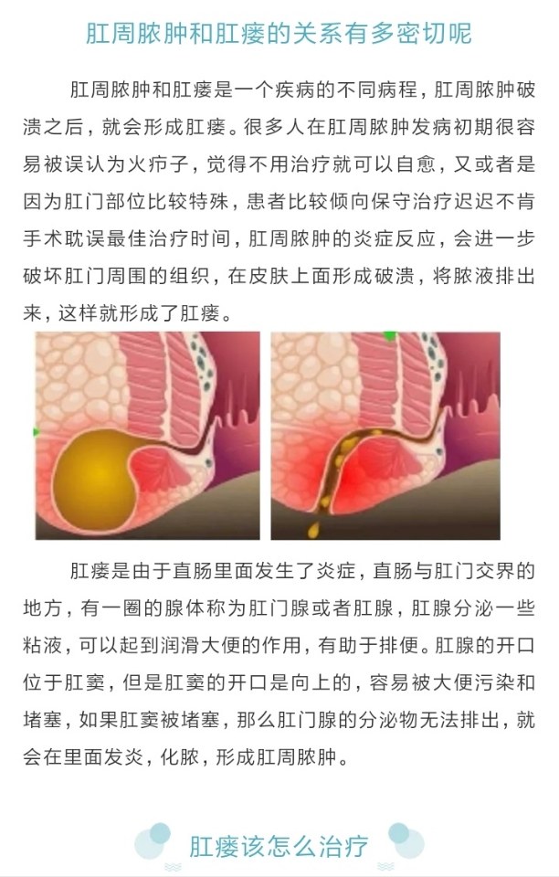 肛周脓肿和肛瘘有什么关系
