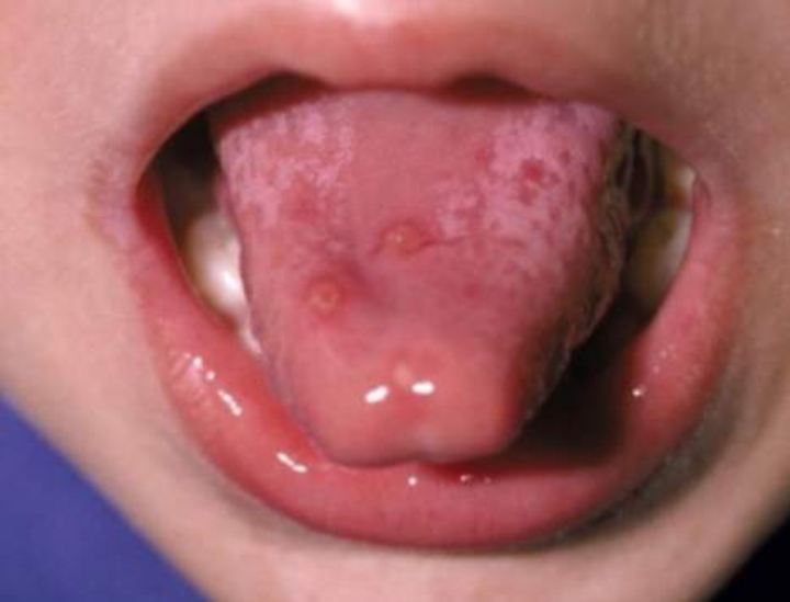 宝宝嘴巴里长泡怎么办