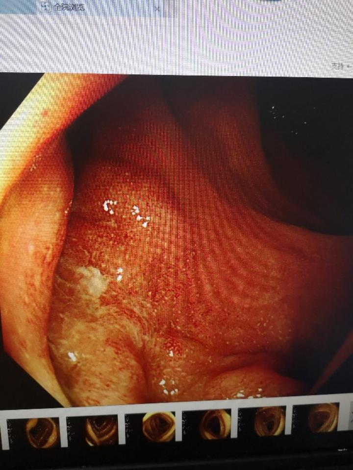青玉散治疗慢性复发型溃疡性直肠炎