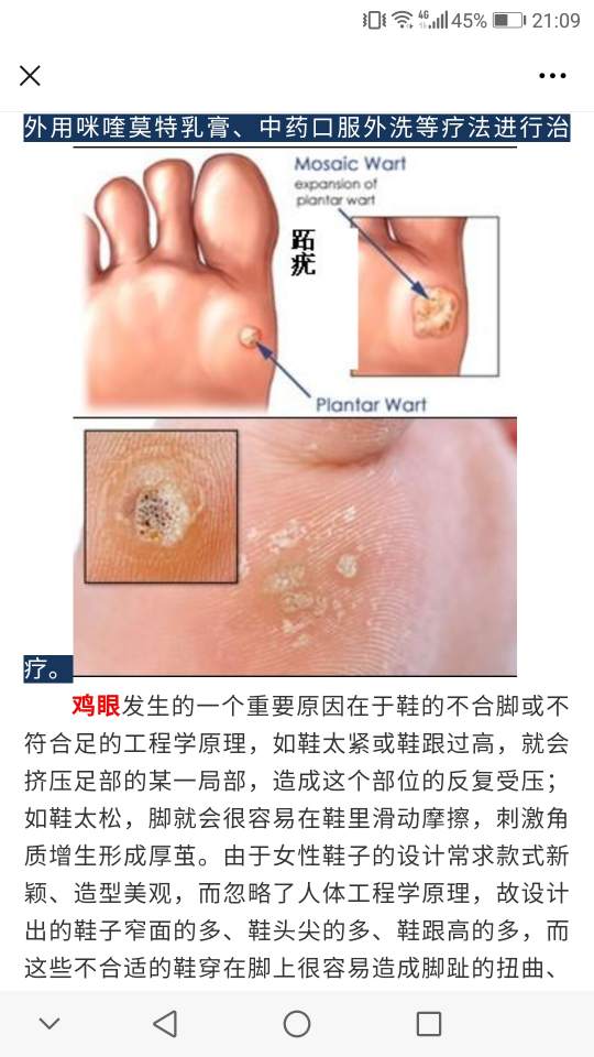 脚上鸡眼怎么去掉图片