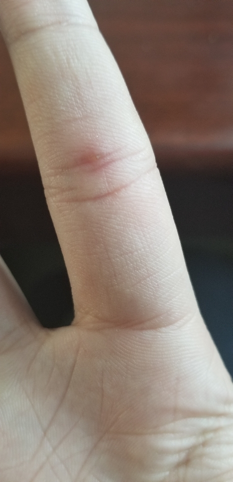 手指指节之间有一个小茧使劲按才痛感觉像是有刺还是什么想问一下这是