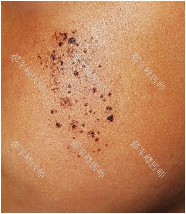 spitz痣主要见于儿童,表现为淡红色或棕色的丘疹,表面光滑,可以长期