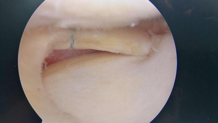 时是膝关节内侧痛,经mri和关节镜确诊为内侧半月板损伤,内侧滑膜皱襞