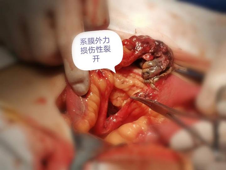 腹部闭合性损伤不容小觑