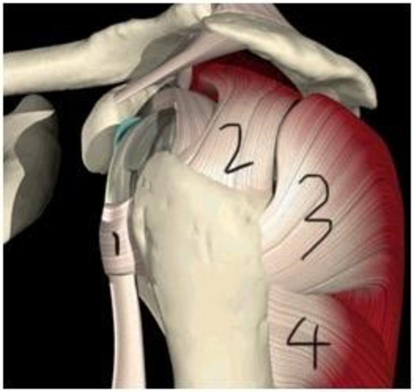 图1图2图3图4肩袖巨大破口(红点轮廓)图5肩袖缝合完整.
