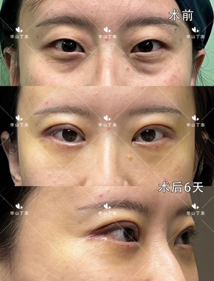 今天这位女生就是同时做了全切双眼皮 外切祛眼袋手术,术后第6天恢复