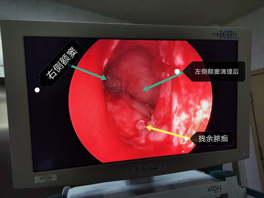 二次手術解剖標誌不清,鼻腔局部瘢痕化,需要熟練掌握額竇解剖和手術徑