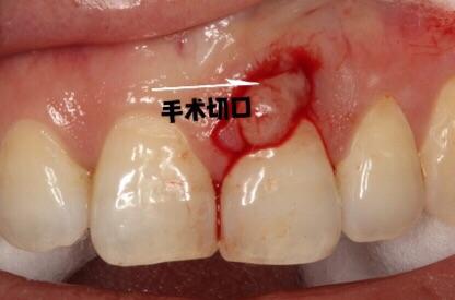 牙龈癌图片手术图片