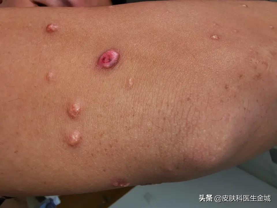 发疹性黄瘤病看上去有点恐怖