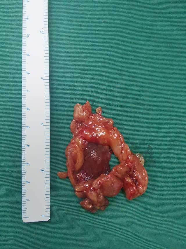 腹腔镜下肾肿瘤的微创手术治疗