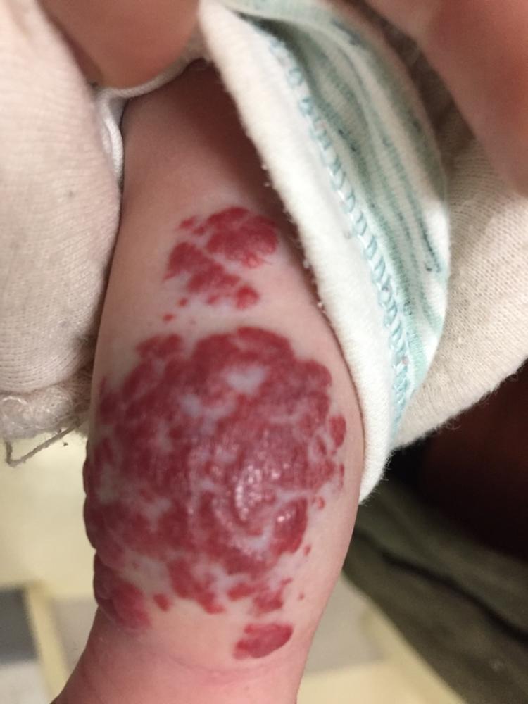 婴幼儿血管瘤宝典分享