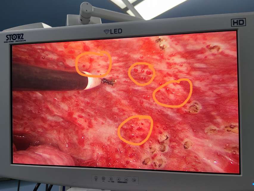 刘懿博士说肺癌五五四四一闪一闪亮晶晶是恶性胸膜间皮瘤不是小星星