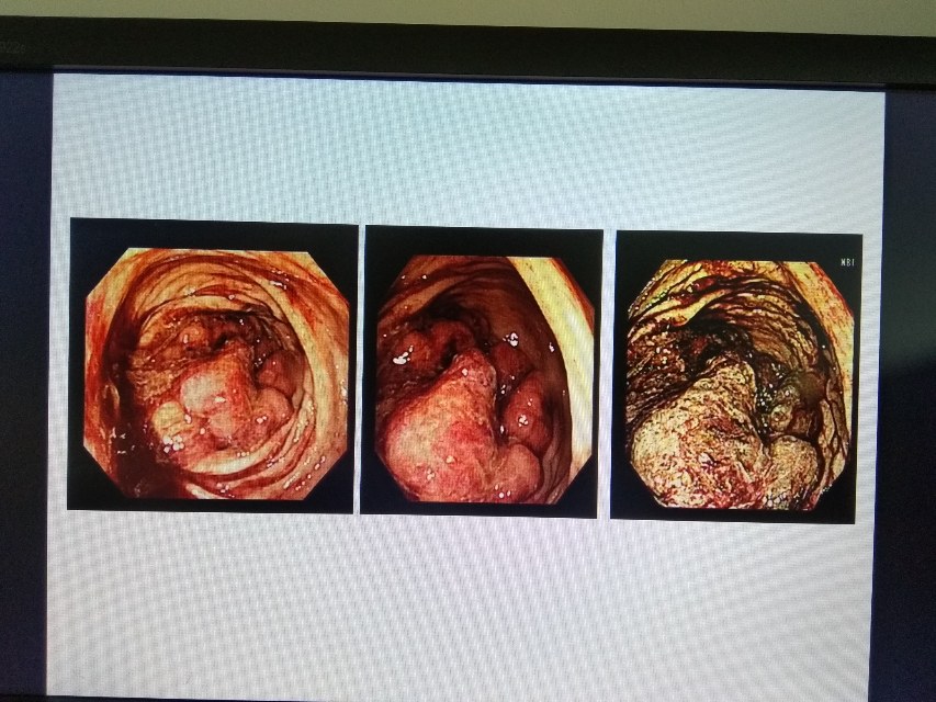 肠镜下肠癌图片