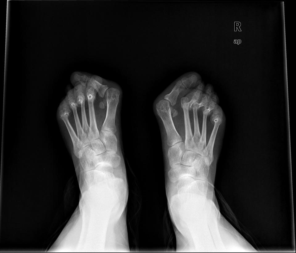 踇外翻——对女性造成困扰最大的足部畸形_刘津浩医生