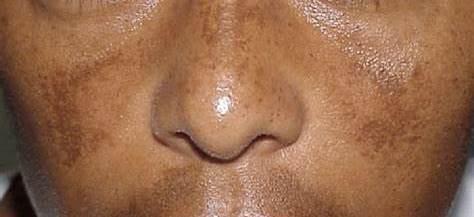 免疫病和皮肤病炎症发作后,都会引起皮肤色素沉着,如常见的红斑狼疮