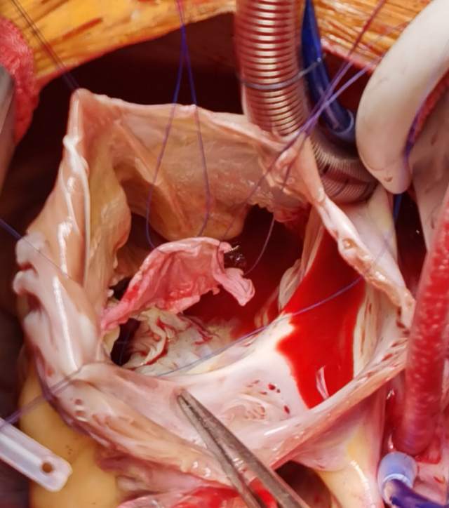 三尖瓣瓣叶拓宽重建技术修复严重三尖瓣关闭不全