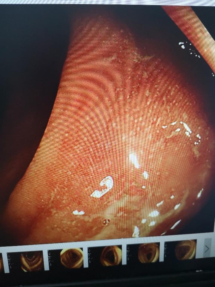 青玉散治疗慢性复发型溃疡性直肠炎