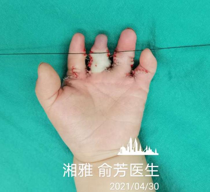 并指分指术后自粘绷带的优秀案例