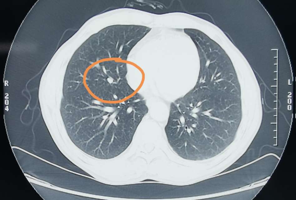 左肺上叶尖后段结节图片