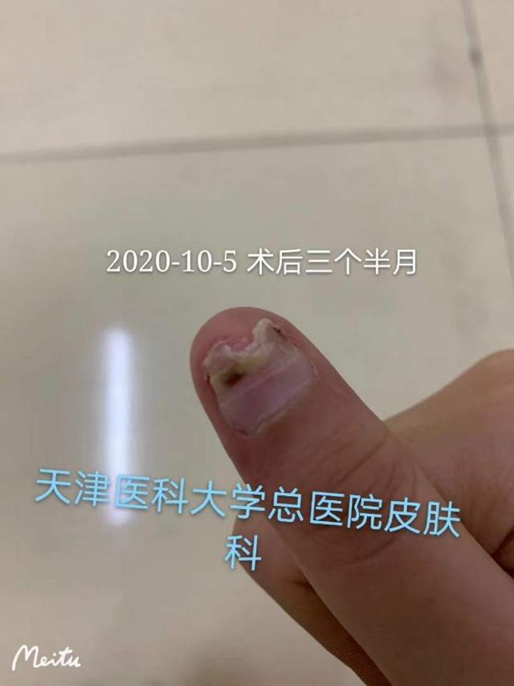 甲母痣甲下黑线手术治疗案例