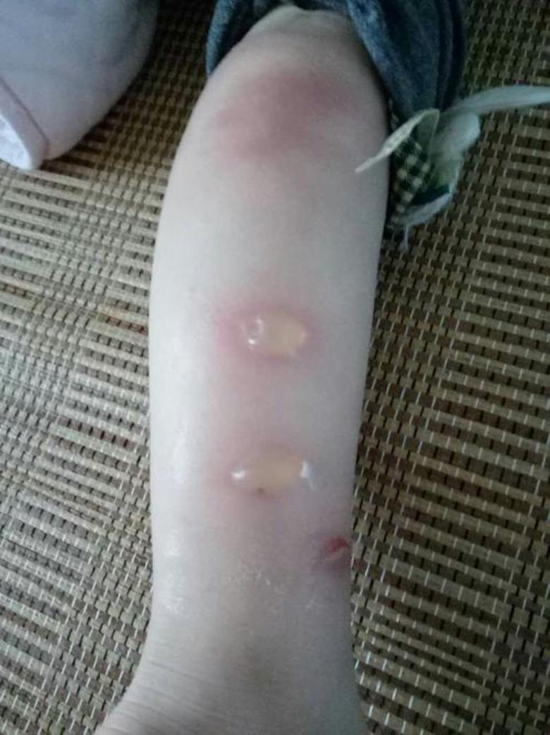 丘疹性荨麻疹虫咬皮炎