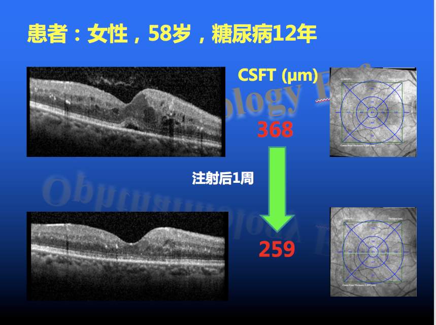 糖尿病黄斑水肿抗vegf治疗两例