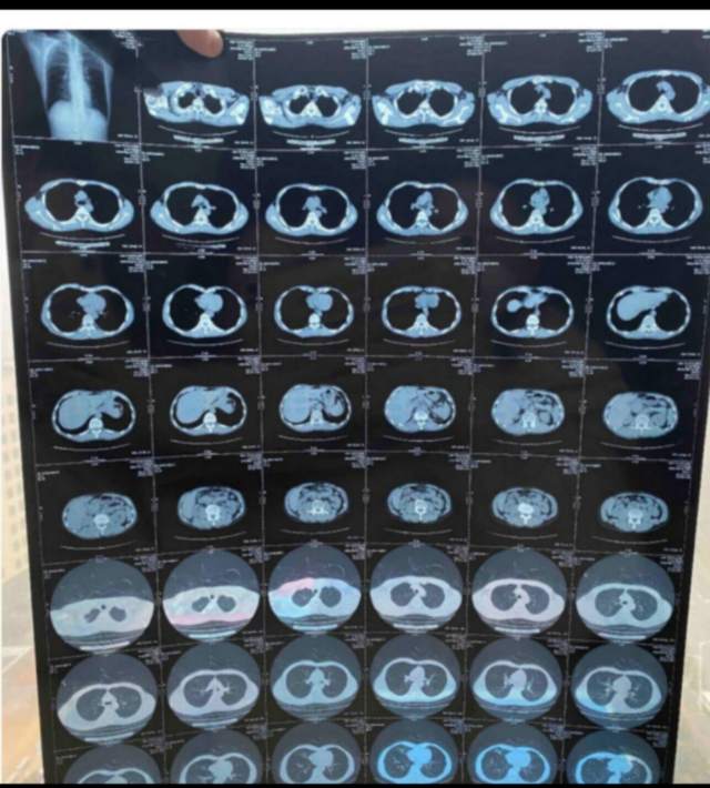 ct读片:胶片,厚层图像,薄层图像哪个最佳?