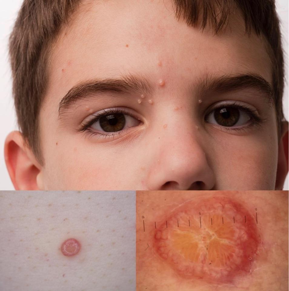 儿童常见疣有哪些?合适接种hpv疫苗吗? - 微医(挂号网)