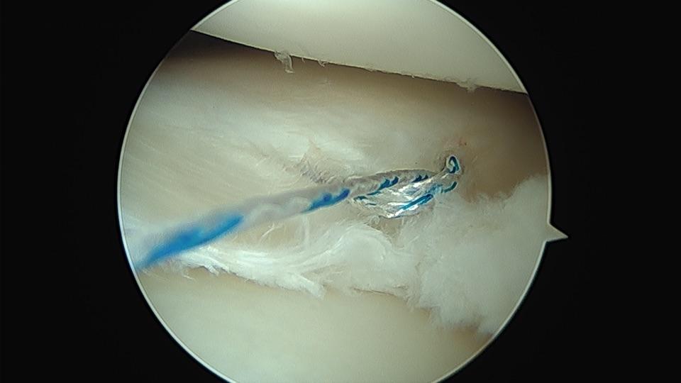 半月板关节镜下缝合病例 - 微医(挂号网)