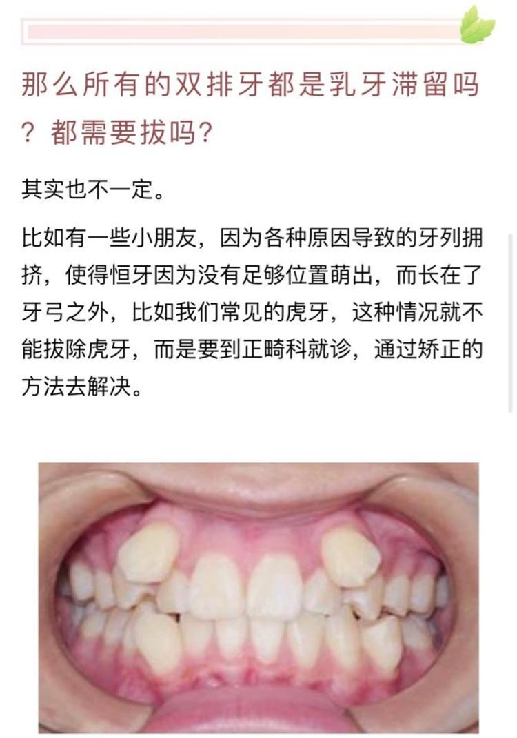 小朋友"双排牙"怎么办? - 微医(挂号网)
