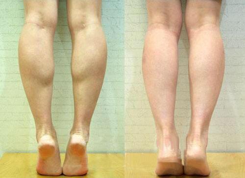 注射微整形-神奇的肉毒素(瘦小腿) - 微医(挂号网)