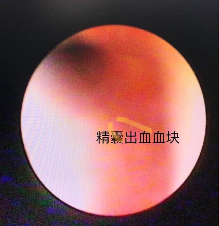 手术工作日志27:精囊炎血精,精囊结石和精囊镜手术,钬激光碎石