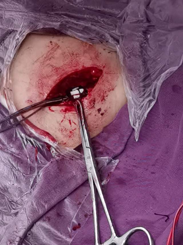 起搏器手术过程图片