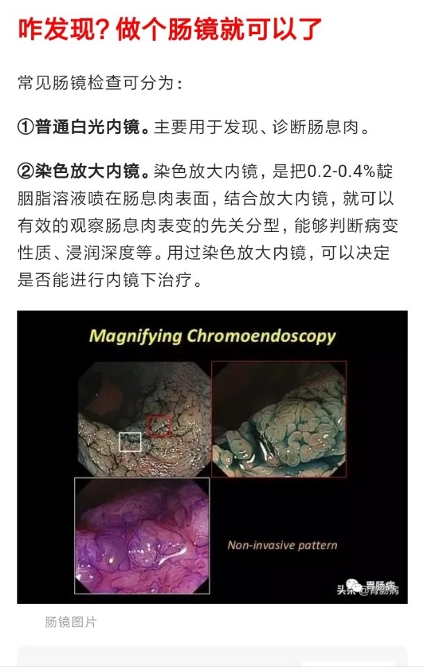 帶你認識結直腸癌的前身腺瘤性腸息肉