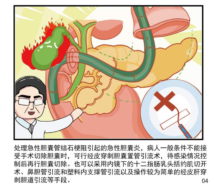 拔鼻胆管步骤动画图片