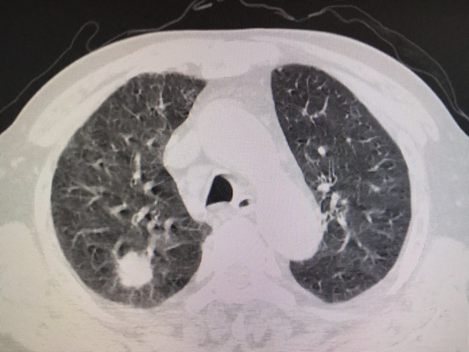 成功完成1例冠心病支架置入合并肺癌患者单孔