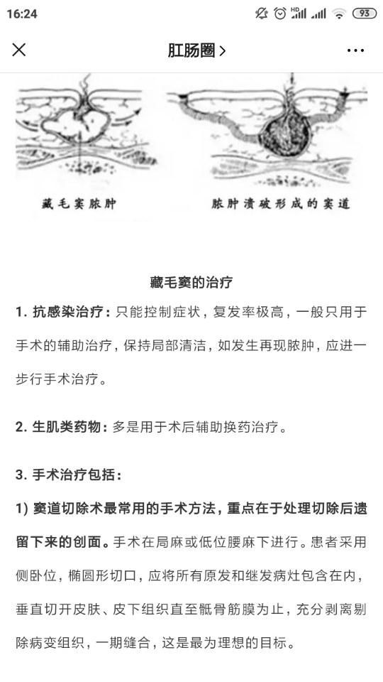 一根毛发引起的手术带你认识藏毛窦