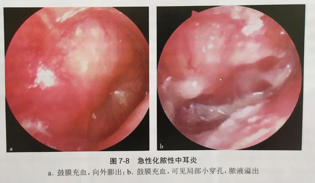 急性化脓性中耳炎的治疗