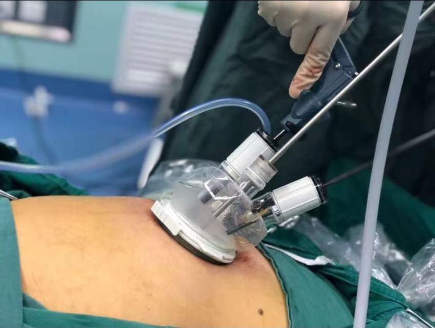 胆囊结石,疝气,阑尾炎等单孔腹腔镜手术治疗(隐瘢痕超微创手术)_全应