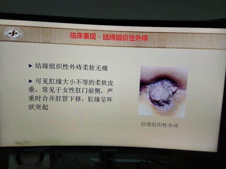 带你认识内痔外痔及混合痔的临床表现
