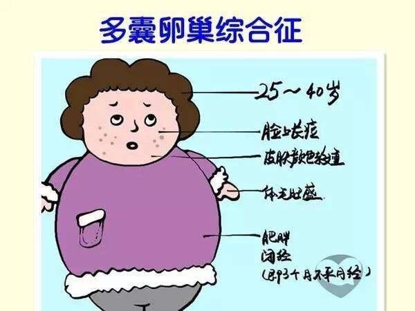多囊卵巢综合征减肥经验分享 - 微医(挂号网)