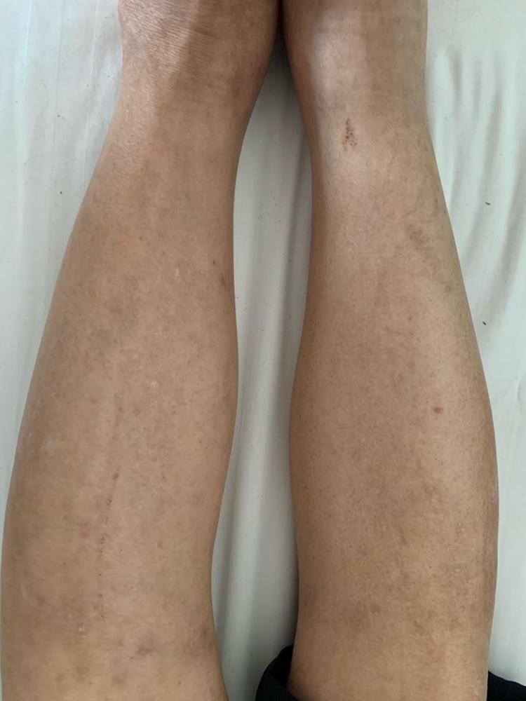 不典型症状的血栓