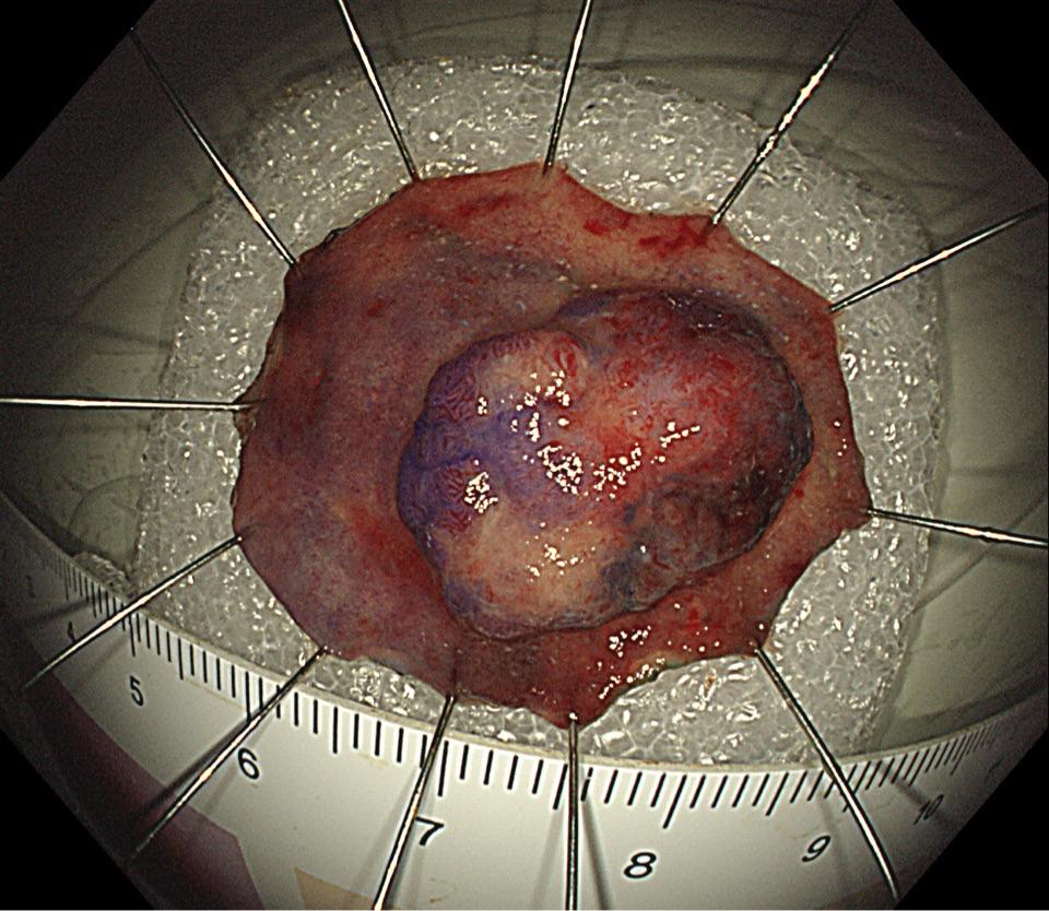 低位直肠肿瘤保肛战成功! - 微医(挂号网)