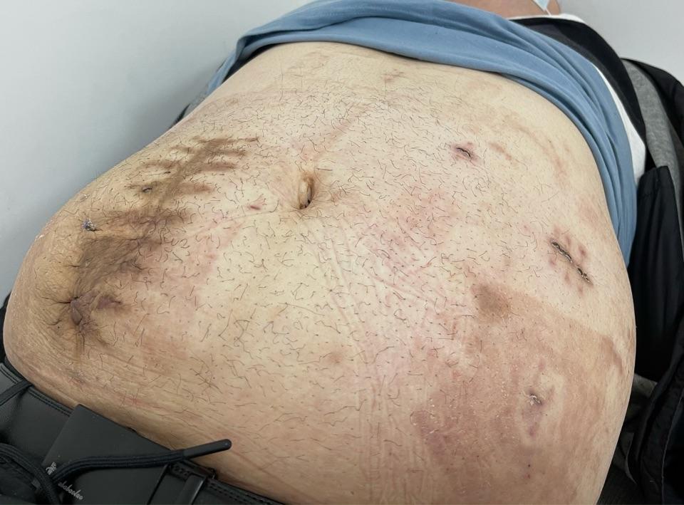 术后恢复可行腔镜下切口疝修补术男,30岁,重240斤,阑尾术后切口疝.