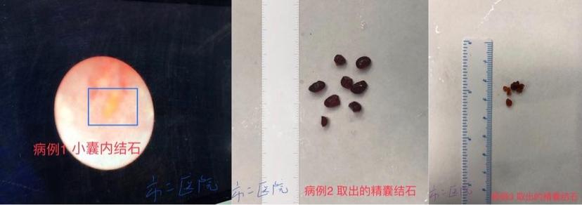 精囊镜技术顽固性血精的治疗利器